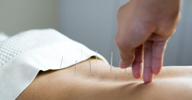 Acupuncture: A Simplified Explanation for Our Outer Banks Friends  image
